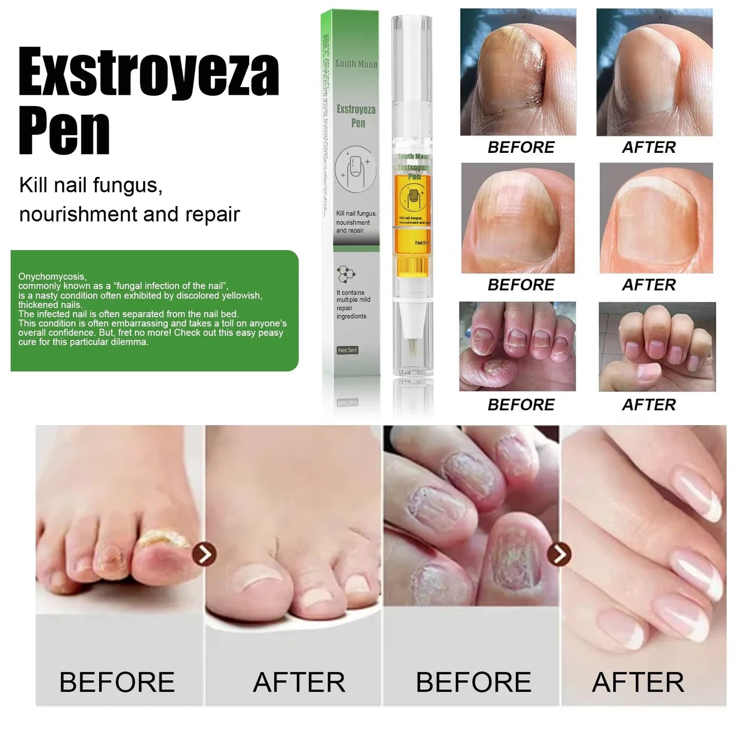 South Moon Nail Fungus Repair Pen Remove Onychomycosis Paronychia Reduce Toe Infection Brighten Nail Hand Foot Nail Care Liquid - SwiftTrends™