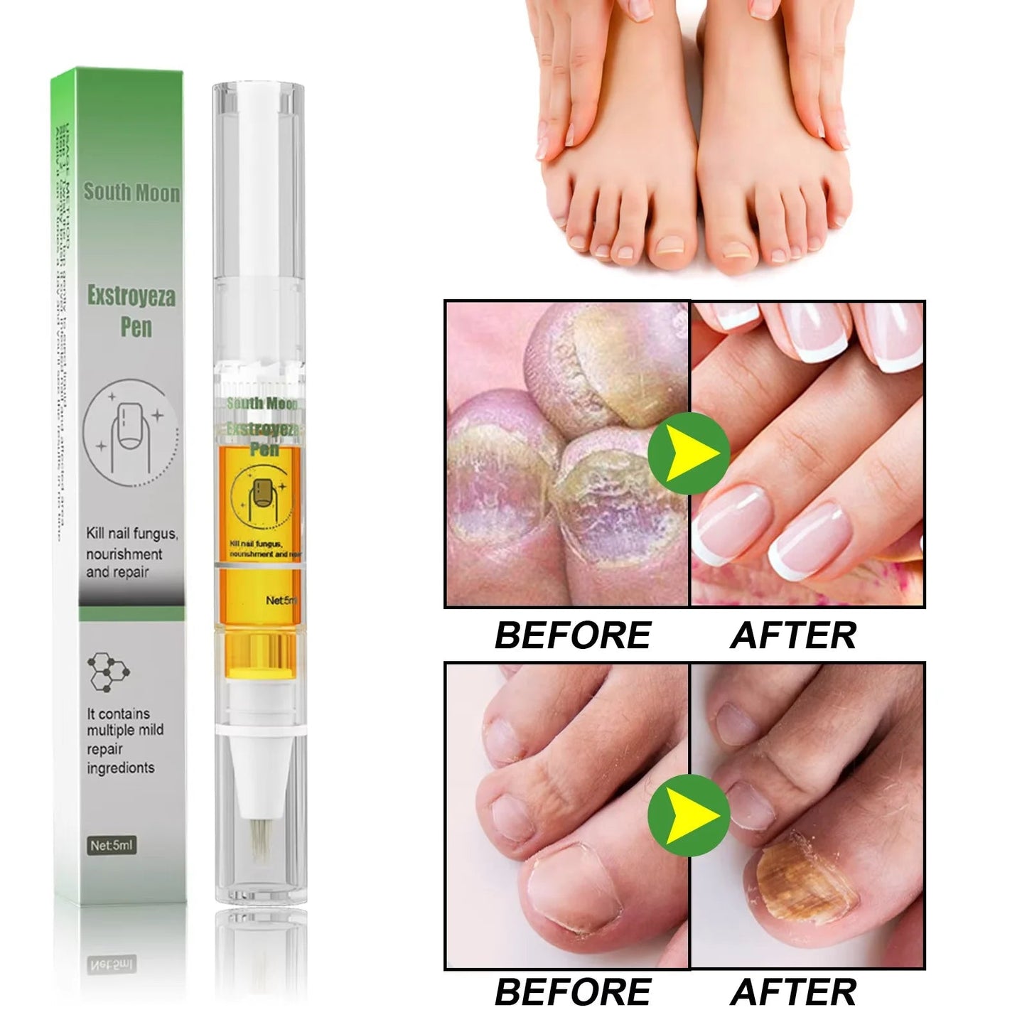 South Moon Nail Fungus Repair Pen Remove Onychomycosis Paronychia Reduce Toe Infection Brighten Nail Hand Foot Nail Care Liquid - SwiftTrends™
